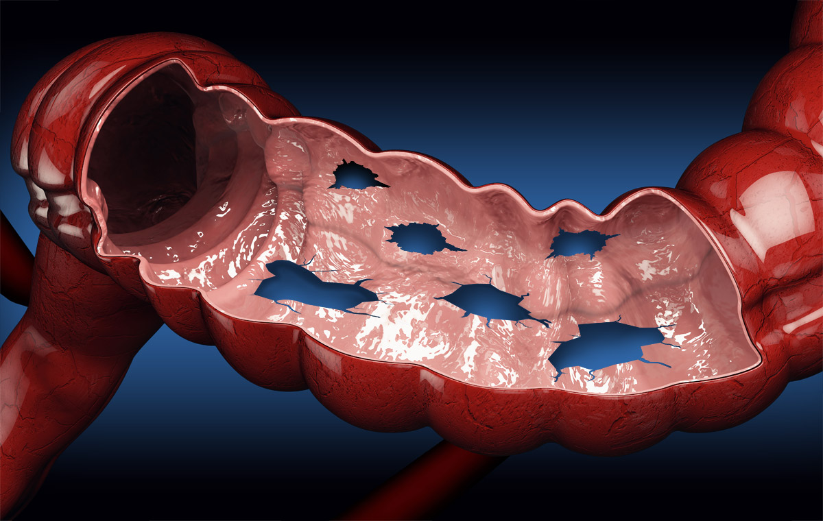 Intestino Normal ¿Cómo restablecer el funcionamiento normal del intestino?